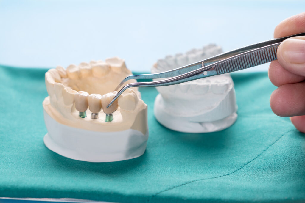 Dental Implants Beaverton OR