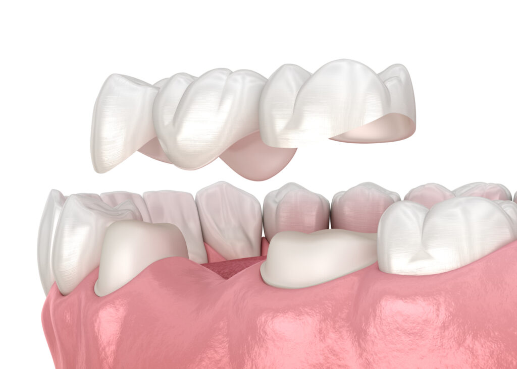 Dental Bridge Beaverton OR